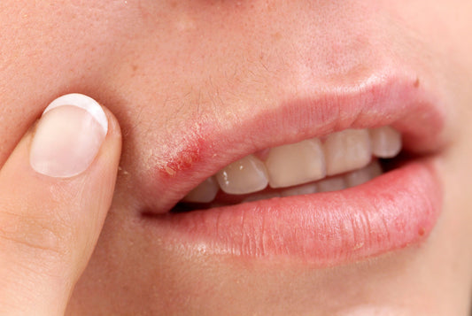 How to Get Rid of Cold Sores Fast: Causes, Treatments, and Home Remedies