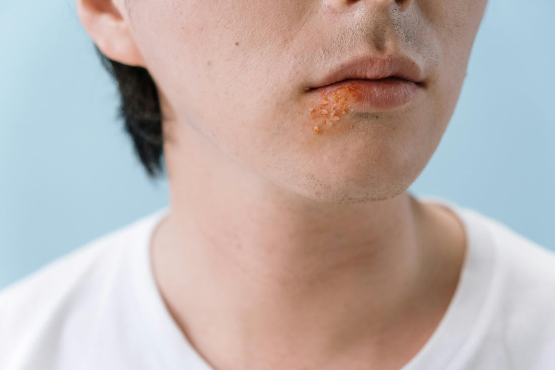 Cold Sore vs. Pimple on Lip: Symptoms, Causes, and Treatments